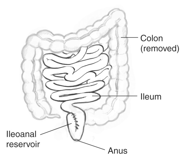 Drawing of the removed colon, labels pointing to the colon (removed), ileum, ileoanal reservoir, and anus.