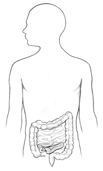 Drawing of the colon, ileum, stoma of the ileum, rectum, and anus within an outline of the human body.