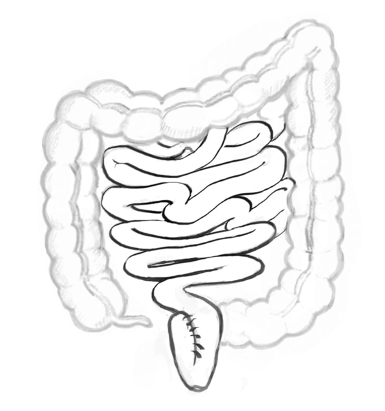 Drawing of the removed colon, which includes the ileum, ileoanal reservoir, and anus.