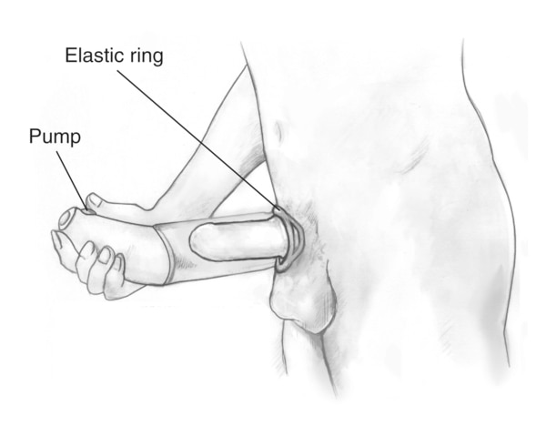 Drawing of a man’s lower torso and a vacuum device over his penis. Labels point to the pump and an elastic ring around the base of the penis.