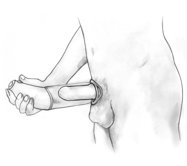 Drawing of a man’s lower torso and a vacuum device over his penis.