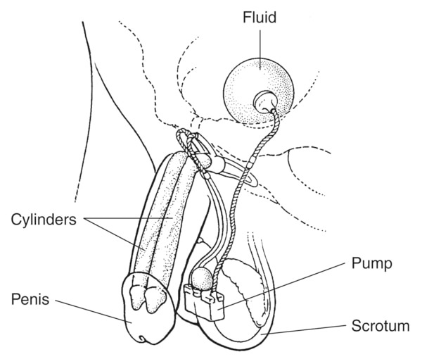 Drawing of a device implanted in the penis. Labels point to two cylinders that run through the penis, a ball of fluid sits in the pelvis, and a pump sits in the scrotum