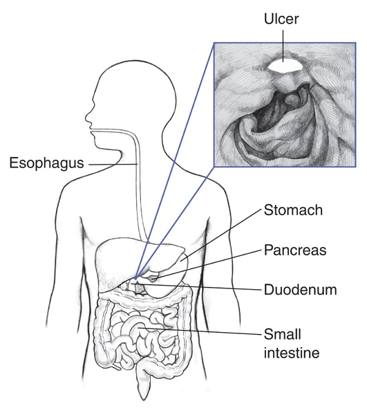 Drawing of the digestive system with the esophagus, stomach, pancreas, duodenum, and small intestine labeled. Inset shows a peptic ulcer.