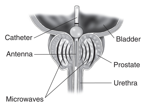 Drawing of a cross-section of the prostate, bladder, and urethra. Labels pointing to a transurethral microwave thermotherapy catheter extends from the urethra into the bladder and an antenna sends microwaves through the catheter to the prostate.
