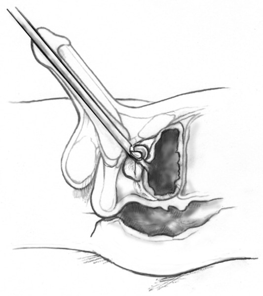 Drawing of a cross-section of the penis, prostate, and bladder.  A resectoscope is inserted through the urethra to the prostate.  A wire loop at the end of the resectoscope cuts tissue from the prostate.