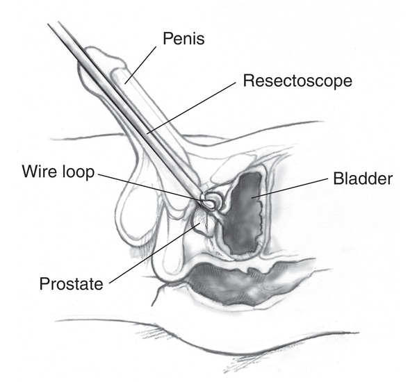 Drawing of a cross-section of the penis, prostate, and bladder. Labels point to resectoscope is inserted through the urethra to the prostate. A wire loop at the end of the resectoscope cuts tissue from the prostate.