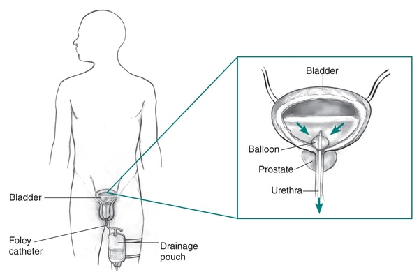 Drawing of a male body, with labels pointing to the bladder, penis, drainage pouch strapped to one leg, and the inserted Foley catheter. Inset of the bladder, prostate, and urethra, showing urine flow from the bladder through the catheter