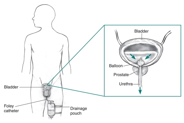 Outline of a male body showing a Foley catheter inserted into the bladder. A drainage pouch is attached to the thigh. An inset image shows a closer view of the flow of urine through the catheter and out the bladder. The catheter is held in place with a balloon.