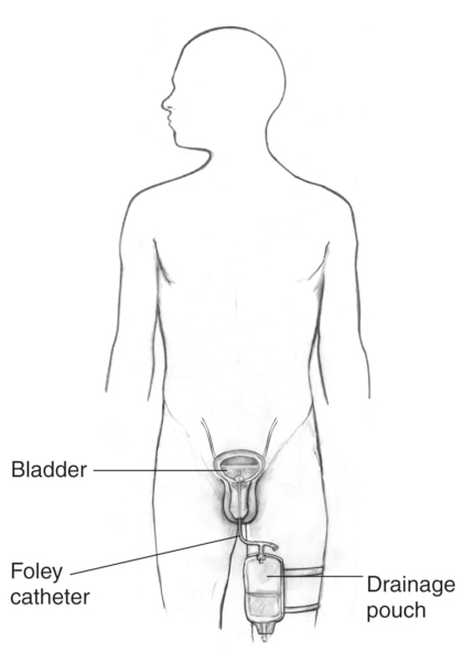 Outline of a male body with labels showing the bladder, penis, drainage pouch strapped to one leg, and the inserted Foley catheter.