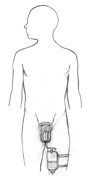 Drawing of a male body showing the bladder, penis, drainage pouch strapped to one leg, and the inserted Foley catheter.
