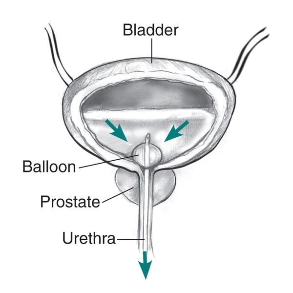 Drawing of the bladder, prostate, and urethra, labels pointing to urine flow from the bladder through the catheter.