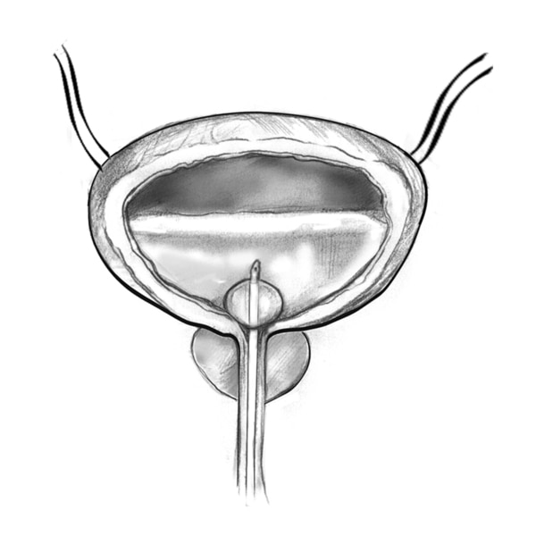 Drawing of the bladder, prostate, and urethra, showing urine flow from the bladder through the catheter