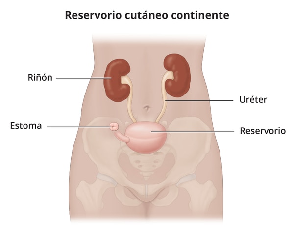 Un reservorio cutáneo continente une los uréteres a una bolsa interna, que se vacía a través de un estoma.