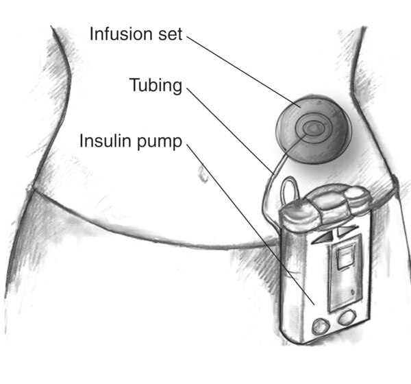 Drawing of female torso with an insulin pump and infusion set. The pump has buttons and a screen and is clipped to the woman’s skirt. Narrow tubing connects the insulin pump to the infusion set attached to the abdomen. The infusion set has a round adhesive patch on the skin covering a cannula inserted under the skin. The infusion set, tubing, and insulin pump are labeled.