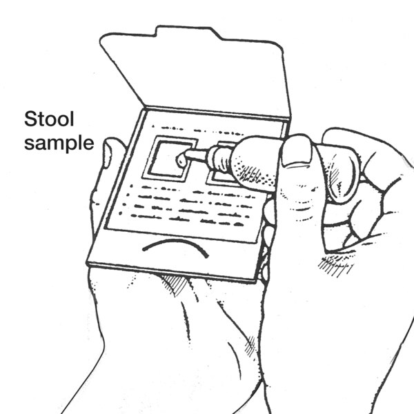 Drawing of hands holding a card containing a stool sample with the stool sample labeled. A drop of liquid is being applied to the stool sample to test for fecal occult blood.