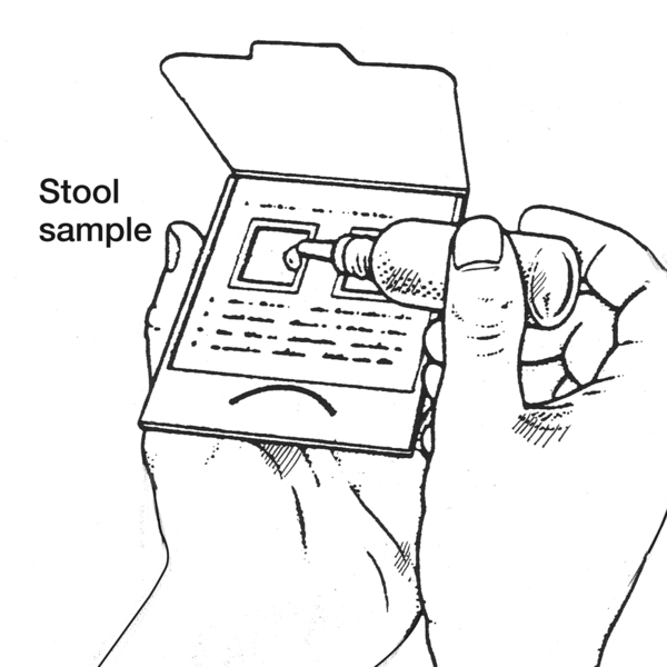 Drawing of hands holding a card containing a stool sample with the stool sample labeled. A drop of liquid is being applied to the stool sample to test for fecal occult blood.