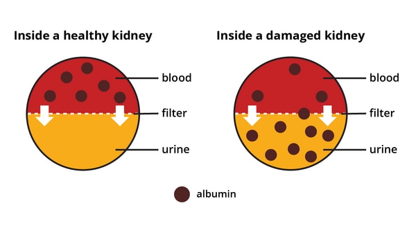 Two diagrams showing that a healthy kidney keeps albumin in the blood, but a damaged kidney allows albumin to pass from the blood into the urine.