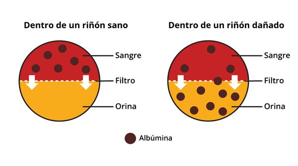 Dos diagramas que muestran que un riñón sano mantiene la albúmina en la sangre, pero un riñón dañado permite que la albúmina pase de la sangre a la orina.