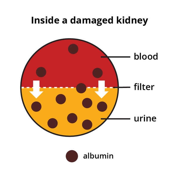 A diagram showing albumin crosses from the blood into the urine in a damaged kidney.