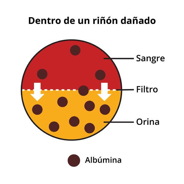 Un diagrama que muestra cómo la albúmina pasa de la sangre a la orina en un riñón dañado.