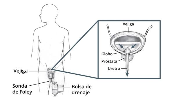 Esquema del cuerpo de un hombre que muestra una sonda de Foley insertada en la vejiga. Una bolsa de drenaje está sujeta al muslo. Un recuadro muestra más de cerca la salida de orina de la vejiga a través de la sonda. La sonda se mantiene en su lugar por medio de un globo.
