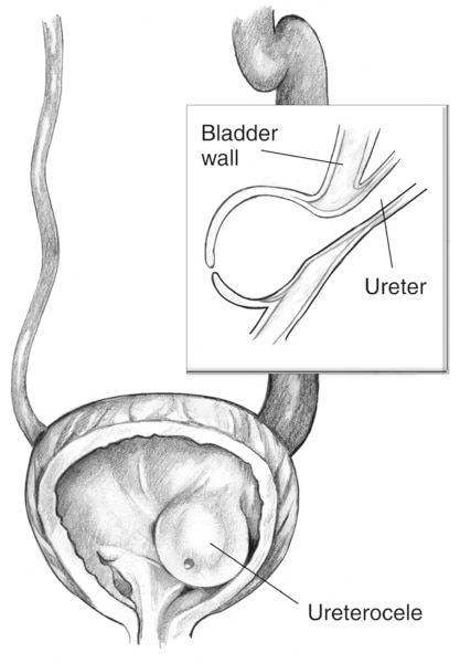 Front-view, cross-section drawing of a bladder and ureter showing a ureterocele. An inset shows a side-view cross section of the obstructed ureter.