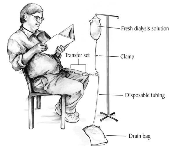 Drawing of a male patient during peritoneal dialysis exchange.