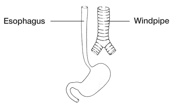 Drawing of an esophagus and stomach beside a windpipe.