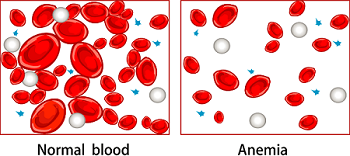 A picture of normal blood cells compared to anemic blood cells.