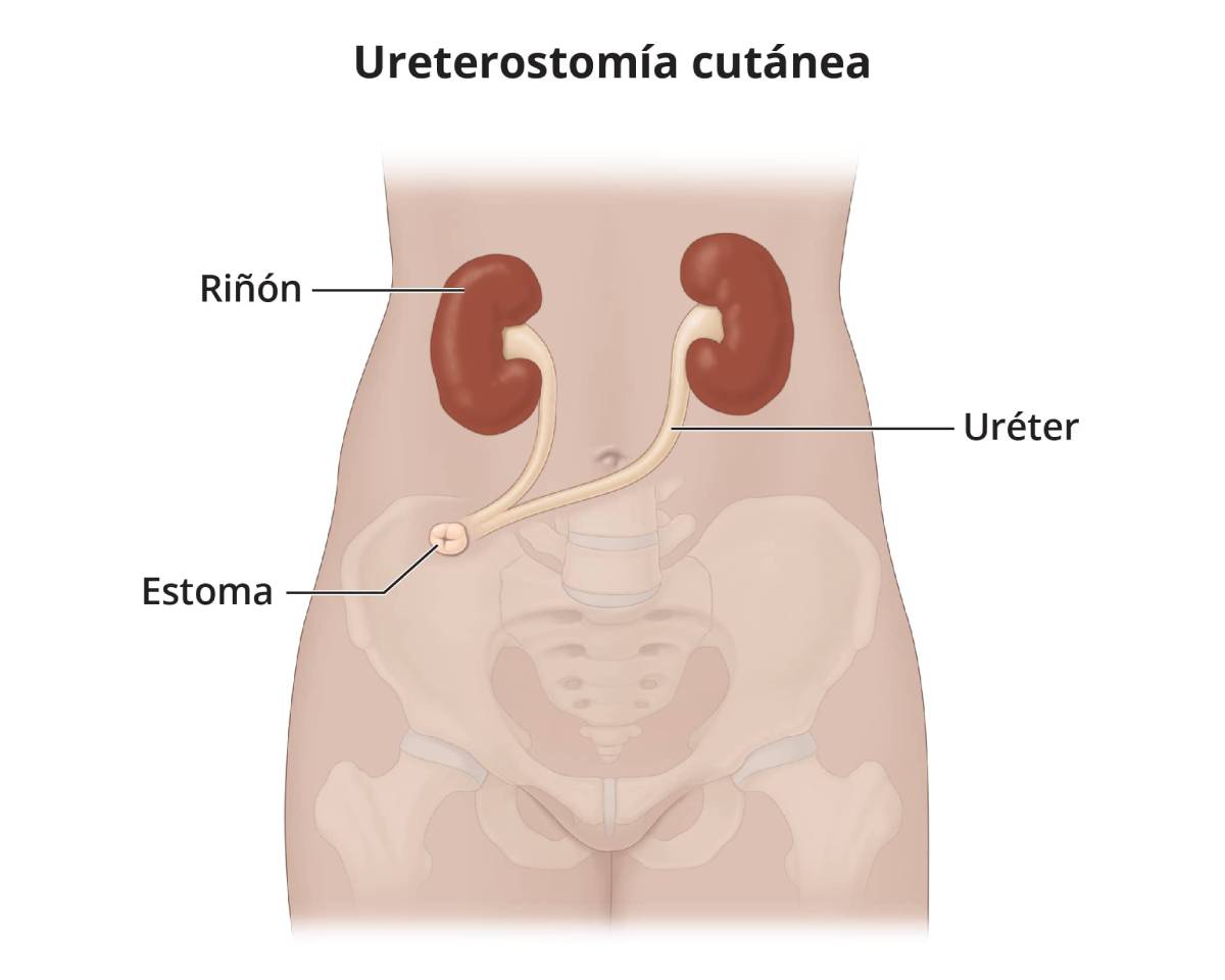 Una ureterostomía cutánea con ambos uréteres unidos a un estoma.