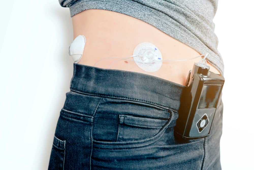A woman wears a continuous glucose monitor on the waistband of her jeans. The sensor and needle are attached to her abdomen.