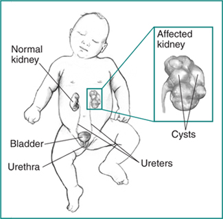Urinary tract in an infant, with labels pointing to a normal kidney, ureters, bladder, and urethra. Inset shows an affected kidney with cysts.