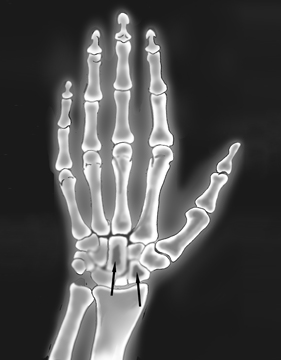 X-ray image of the hand and wrist, with arrows pointing to darkened areas in two wrist bones, indicating amyloid deposits.