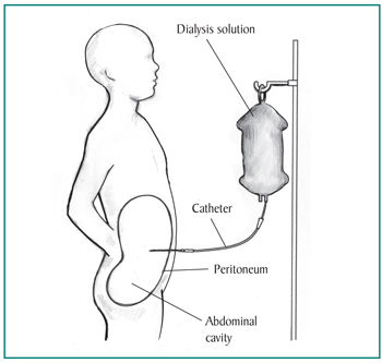 Picture of a child receiving peritoneal dialysis treatment. Labels point to the dialysis solution, catheter, peritoneum, and abdominal cavity.