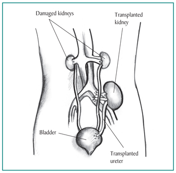 Picture of a transplanted kidney inside an outline of the abdomen. The two damaged kidneys are still in place on either side of the spine, just below the rib cage. The transplanted kidney is located on the left side, just above the bladder. A transplanted ureter connects the new kidney to the bladder. Labels point to the damaged kidneys, transplanted kidney, bladder, and transplanted ureter.