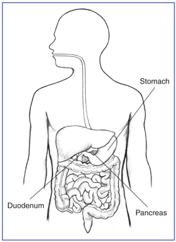 Picture of the digestive tract within an outline of the top half of a human body. The stomach, pancreas, and duodenum are labeled.