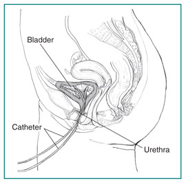 Drawing of the side view of the male urinary tract with a catheter inserted through the urethra to the bladder. The catheter, urethra, and bladder are labeled.