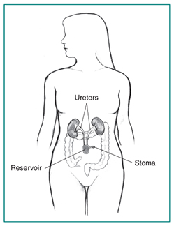 Drawing of a continent cutaneous reservoir. Labels point to the reservoir, two ureters, and a stoma.