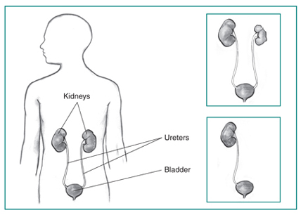 Picture of urinary tract in an outline of the top half of a human body. Inset of one kidney and the bladder and one kidney, nonworking kidney, and the bladder.