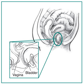 Drawing of a woman’s pelvic area with an inset enlargement of the vagina, bladder, and cystocele.